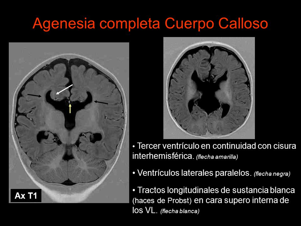adelgazamiento del cuerpo calloso consecuencias